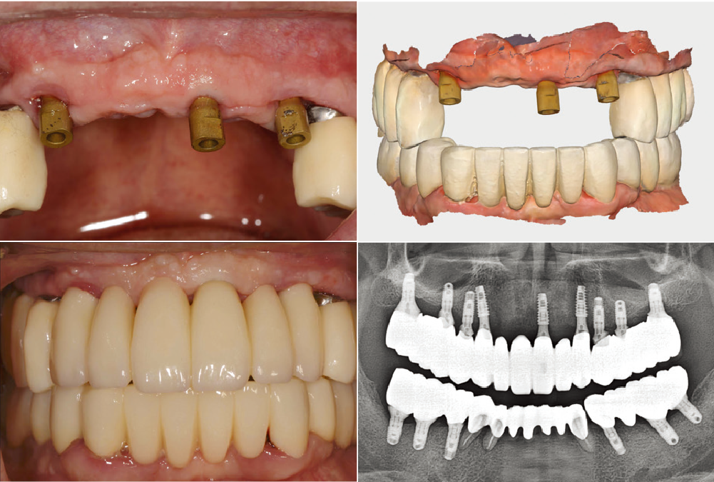 Implant restoration by digital impression