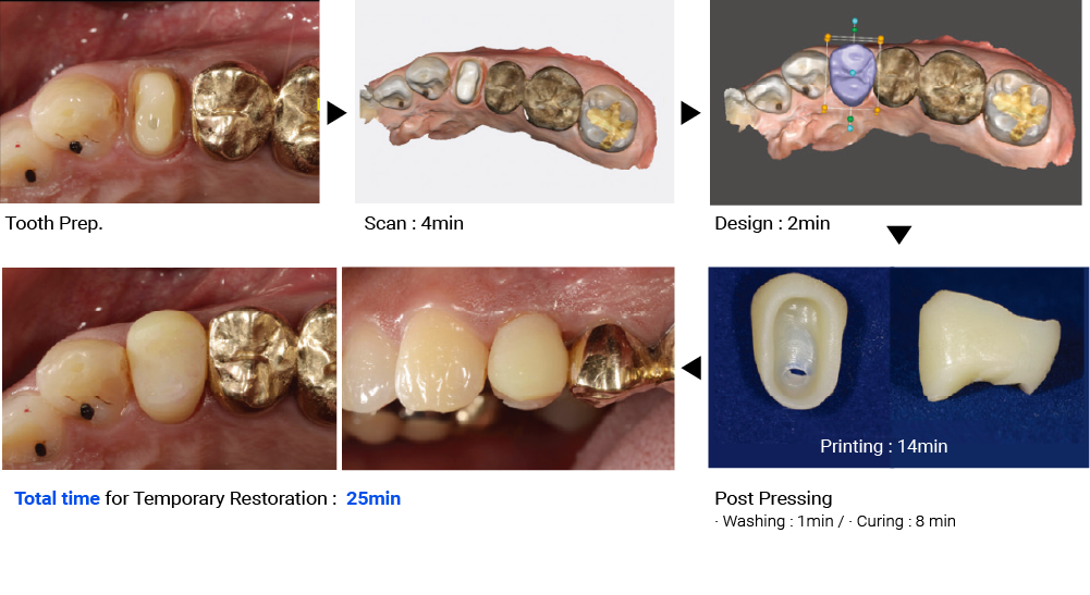 Single temporary crown by 3D printing