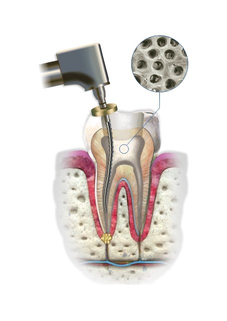 CERKAMED-Citric Acid -Liquid for Rinsing Root Canals 5