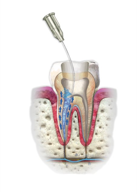 CERKAMED-Citric Acid -Liquid for Rinsing Root Canals 6