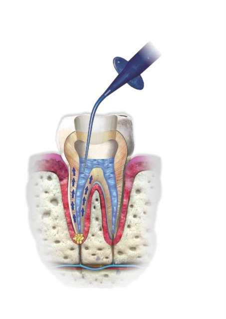 CERKAMED-Citric Acid -Liquid for Rinsing Root Canals 7
